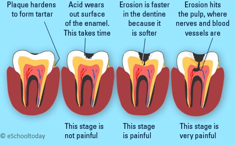 Cavity and Tooth Erosion Illustration