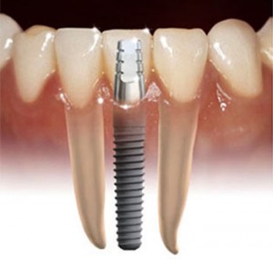 Dental Implant Internal Illustration