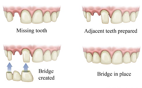 Dental Bridge Illustration - Missing Tooth and Bridge