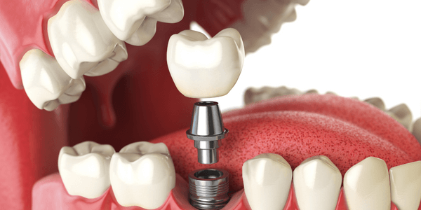 Dental implant crown