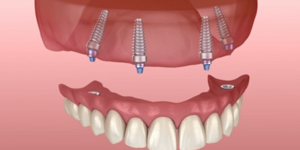 all-on-4-dental-implant