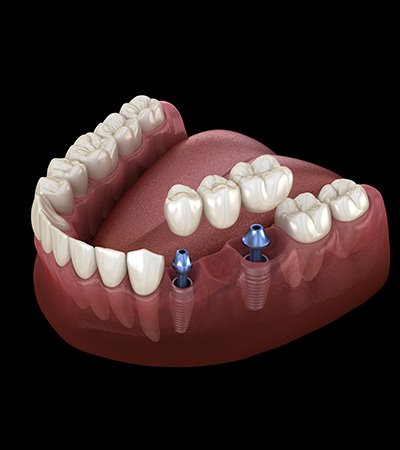 Dental implant bridge