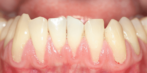 Gum disease cause