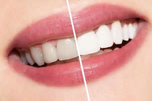 Teeth whitening at Surbiton Dental