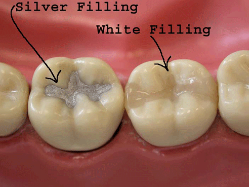 Dental Filling White