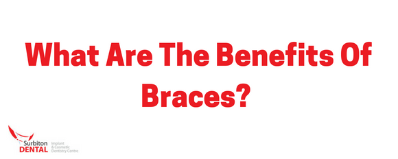 What Are The Benefits Of braces? | Surbiton Dental
