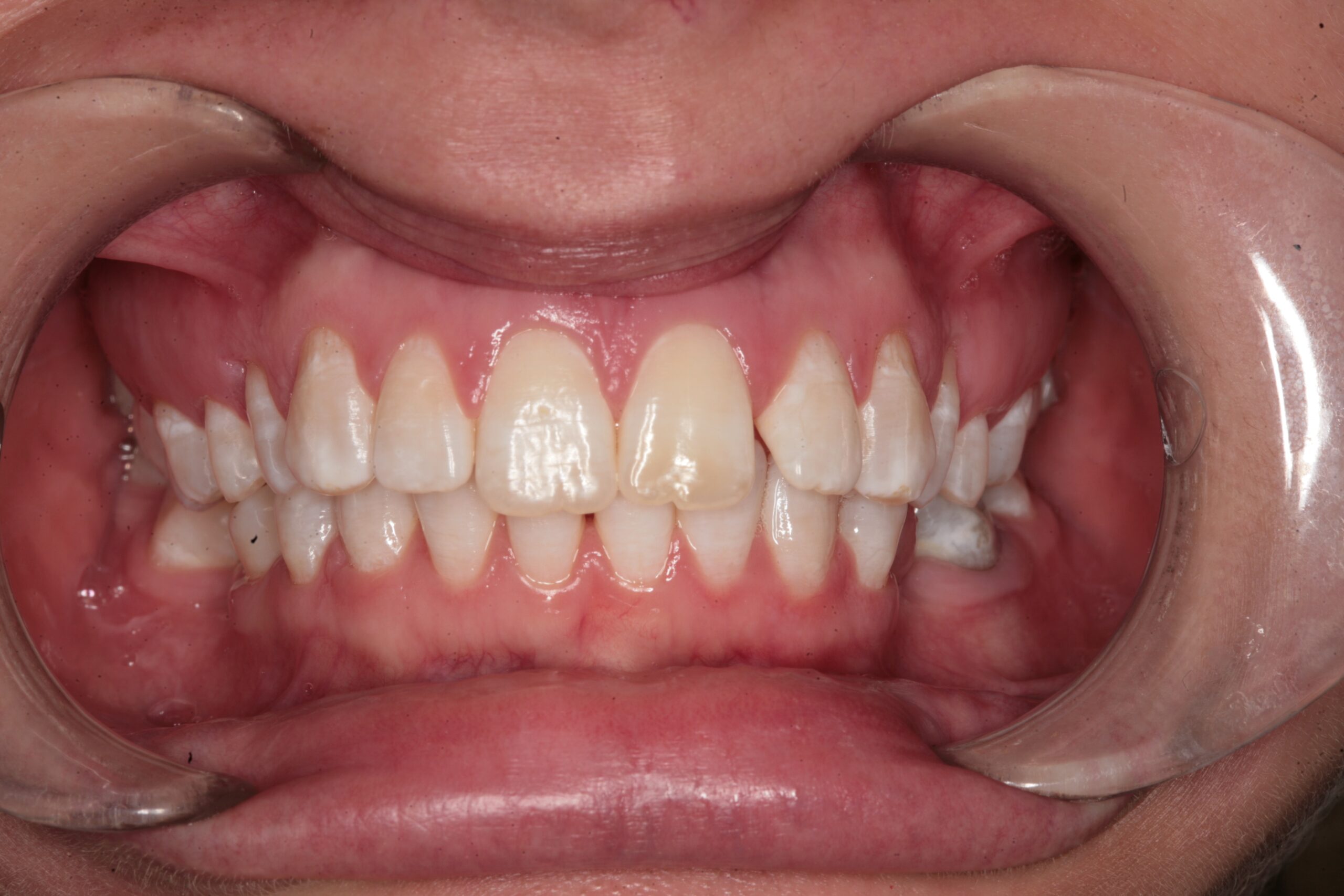 Case 5 (Before) treating at Surbiton Dental