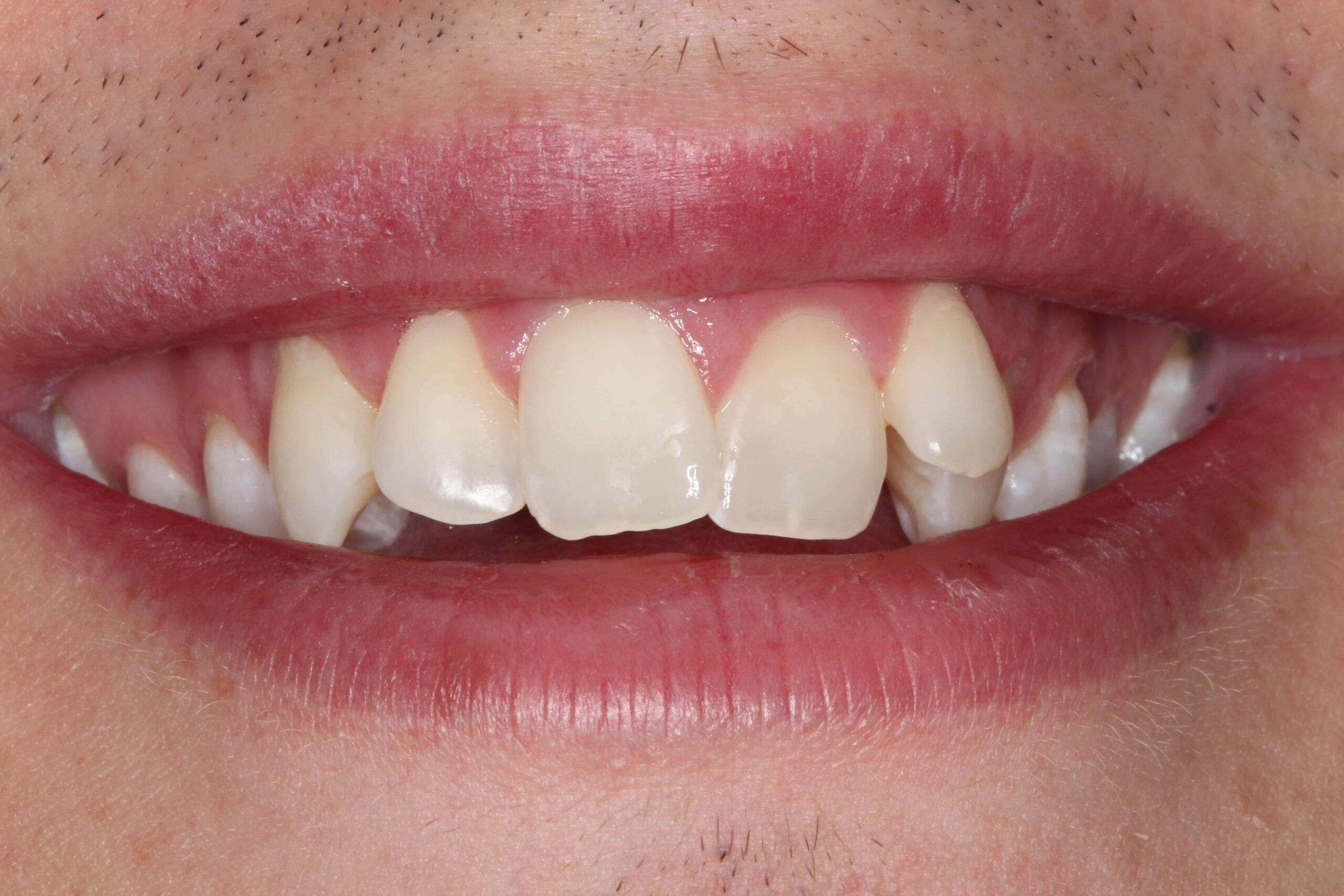 Case 9 (After) treating at Surbiton Dental