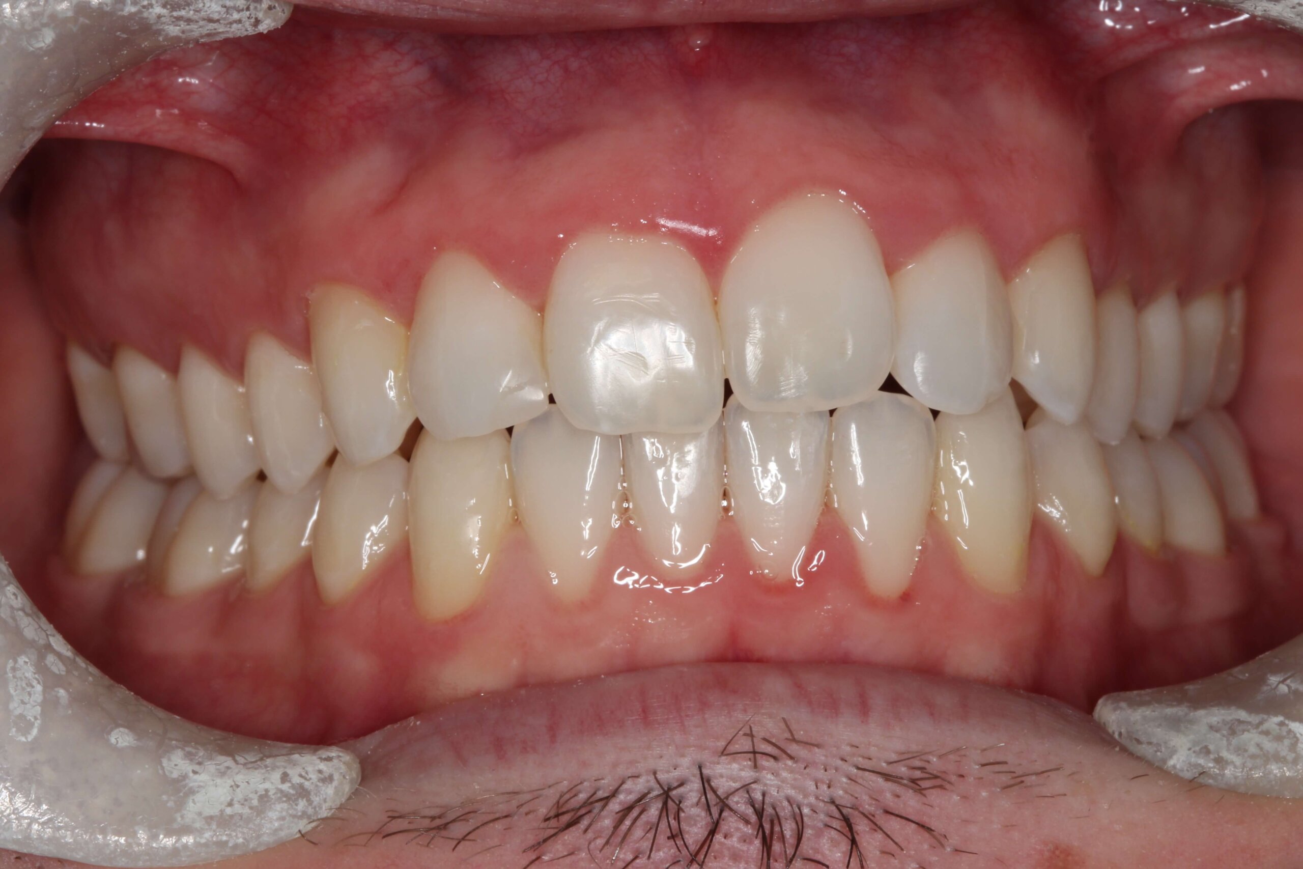 Case 4 (After) treating at Surbiton Dental