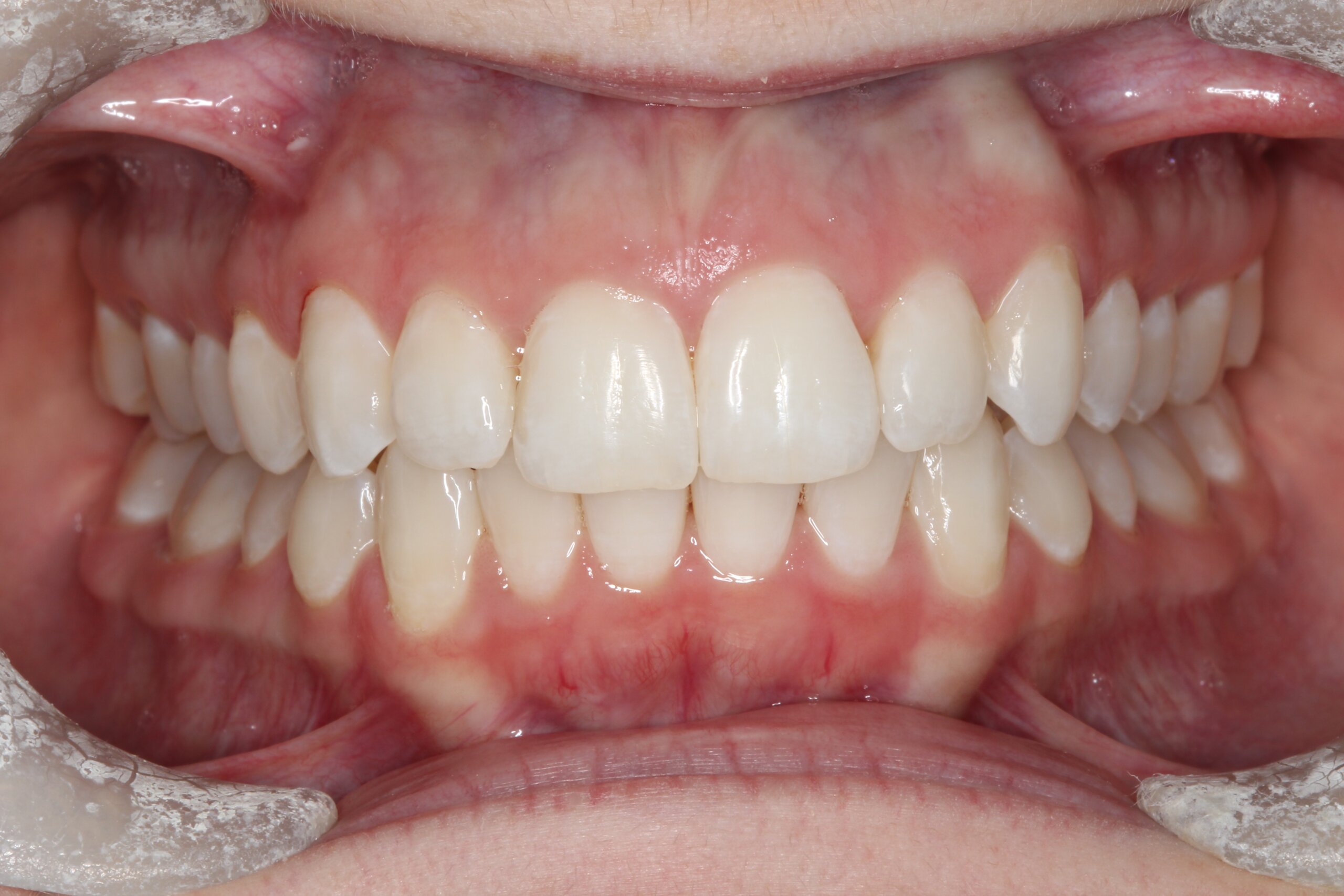 Case 2 (After) treating at Surbiton Dental