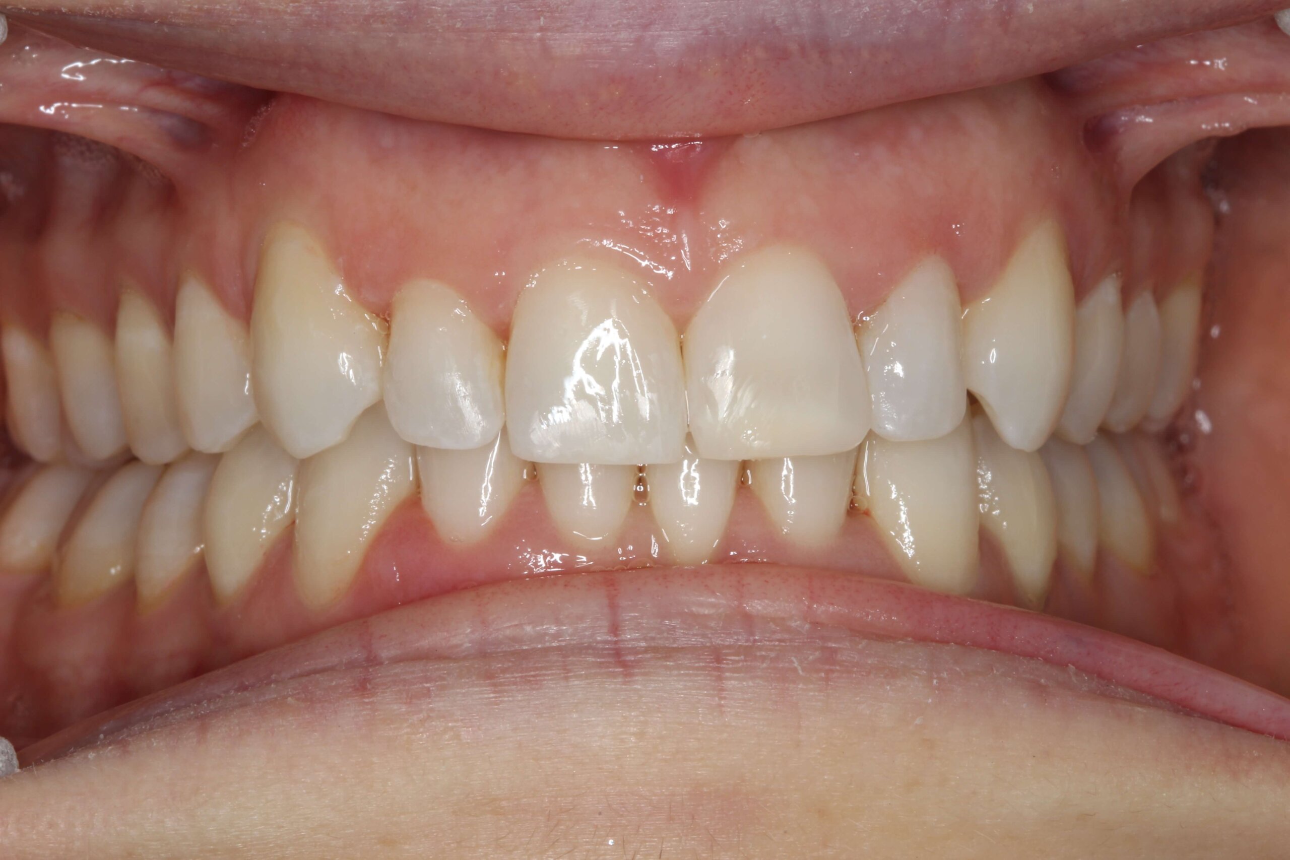 Case 3 (After) treating at Surbiton Dental