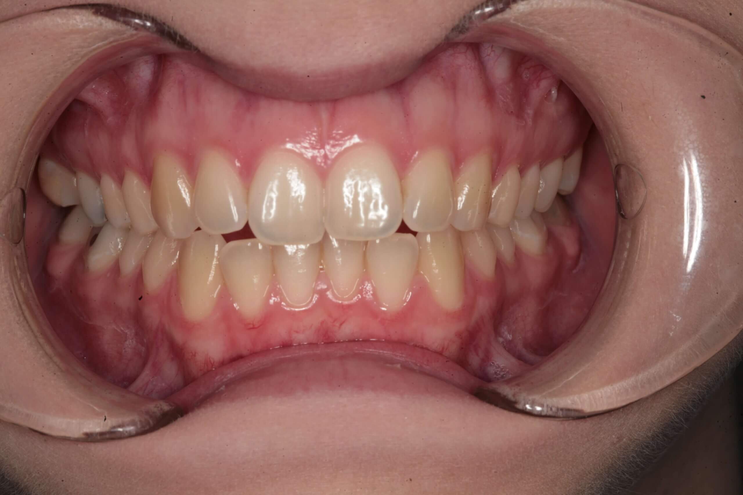 Case 1 (Before) treating at Surbiton Dental