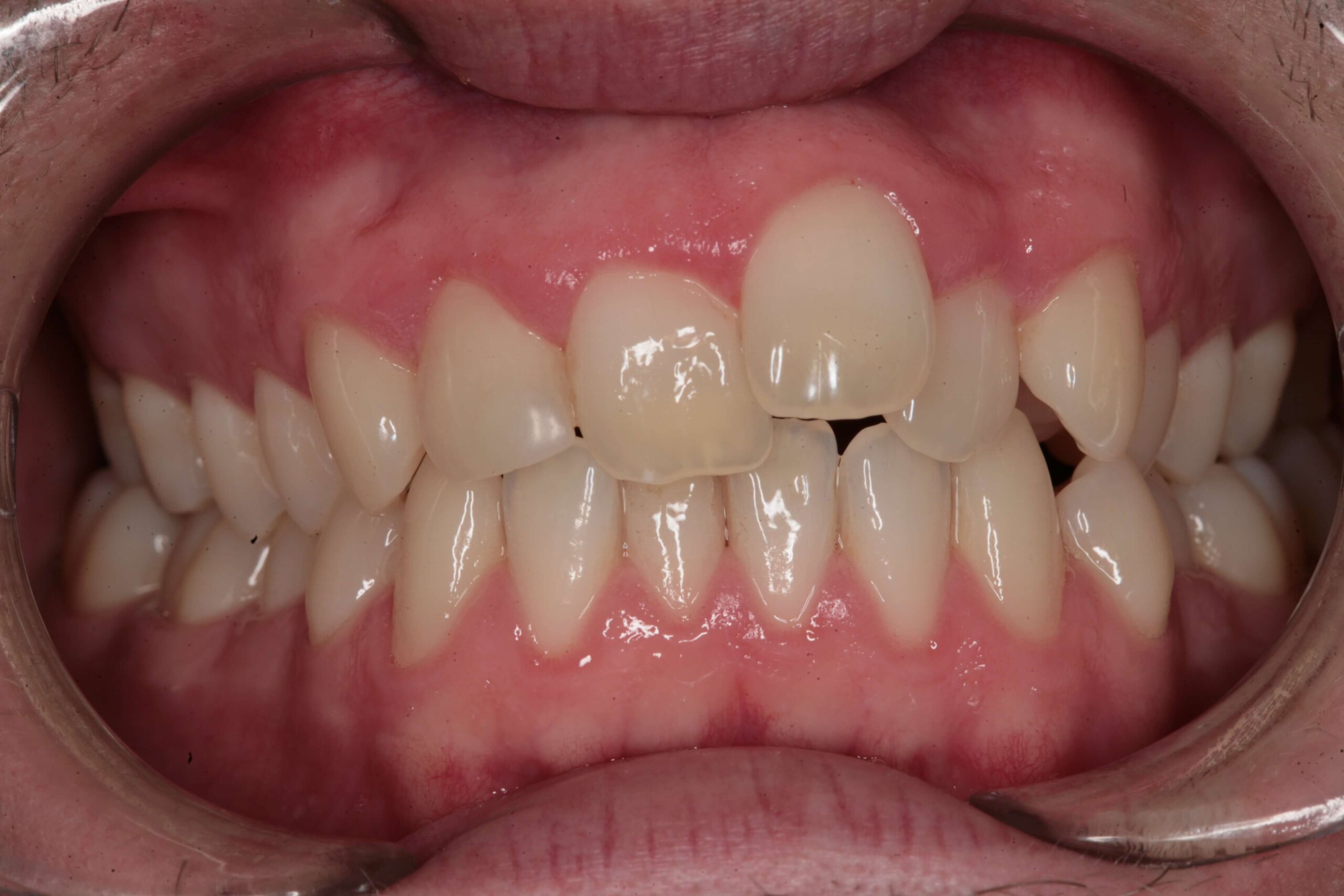 Case 4 (Before) treating at Surbiton Dental