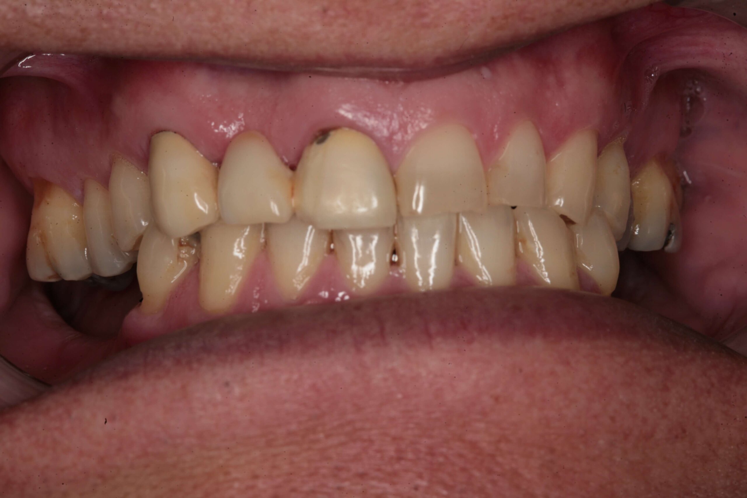 Case 8 (Before) treating at Surbiton Dental