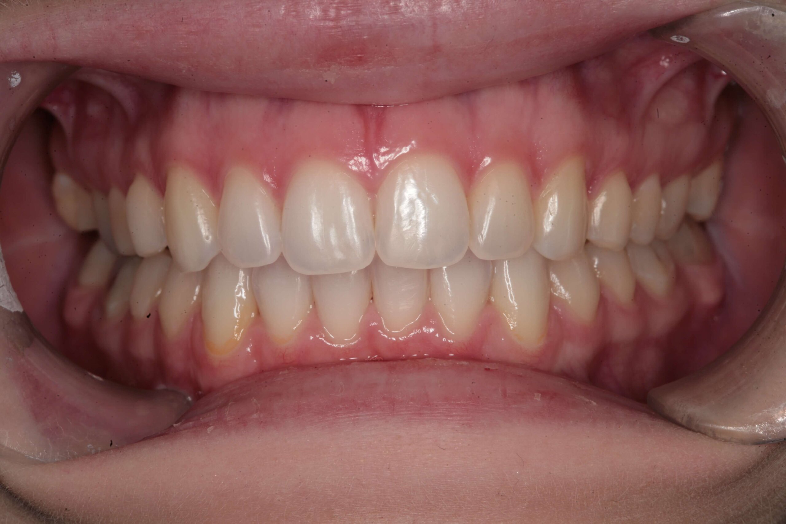 Case 1 (After) treating at Surbiton Dental