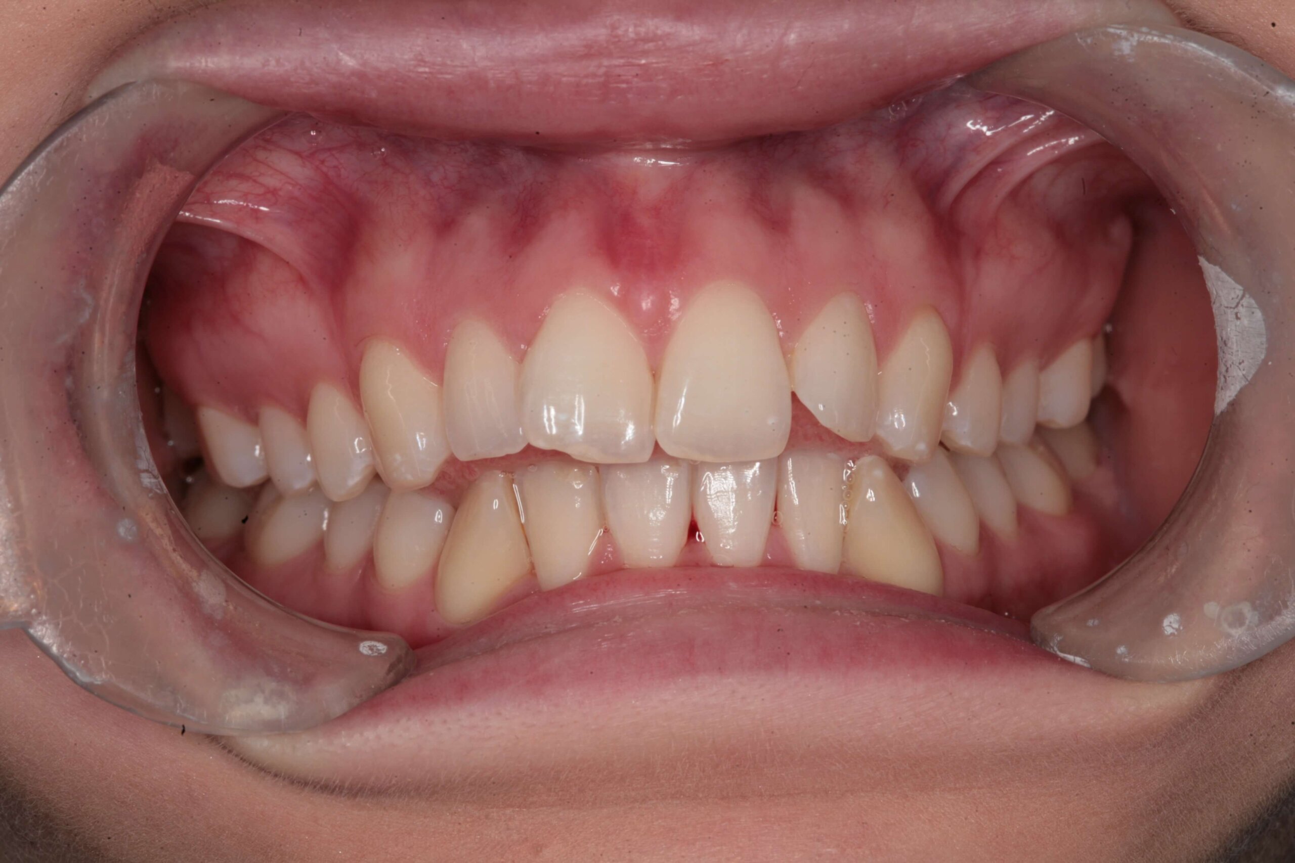 Case 6 (Before) treating at Surbiton Dental