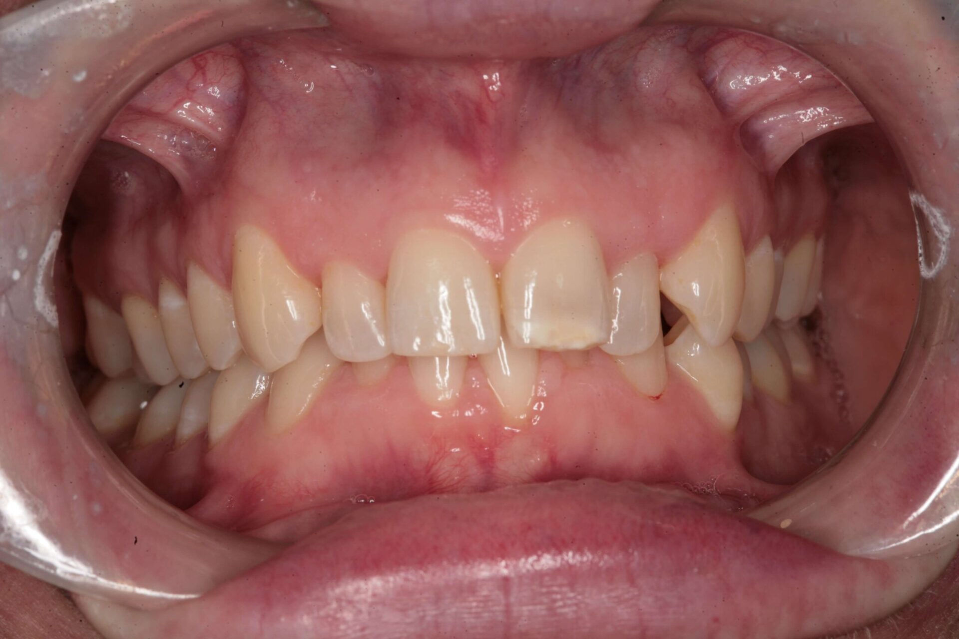 Case 3 (Before) treating at Surbiton Dental