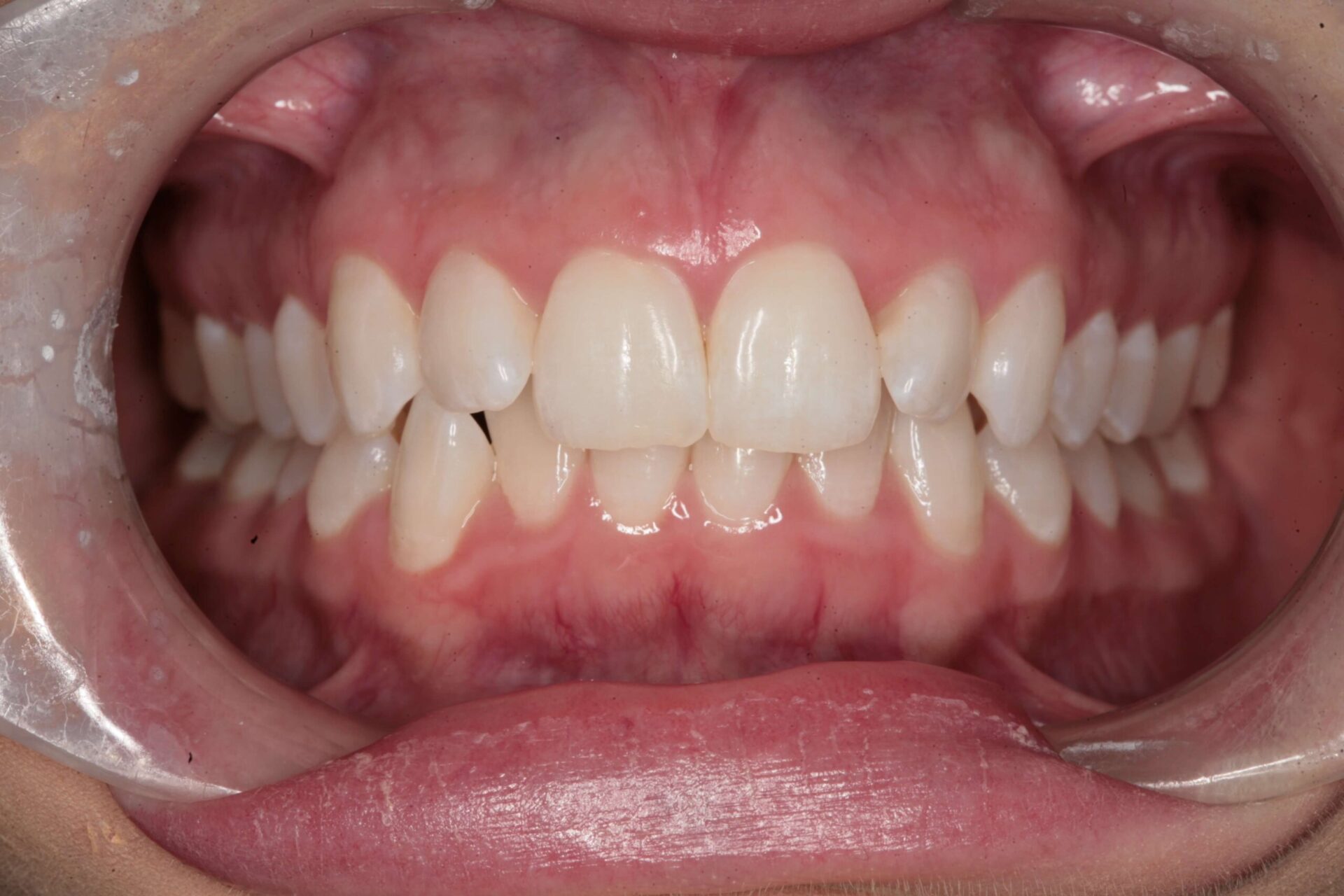 Case 2 (Before) treating at Surbiton Dental