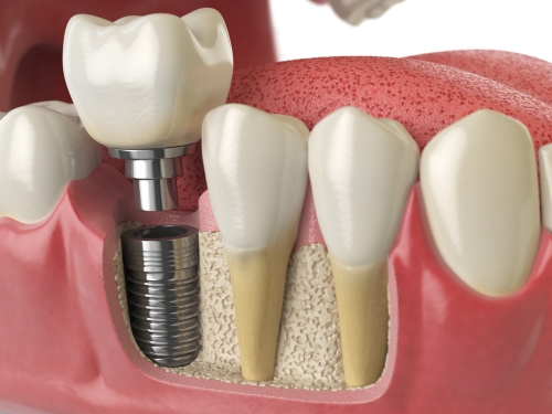 cosmetic dental implant