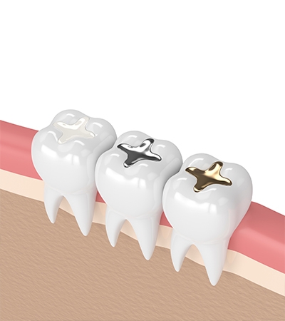 dental filling white
