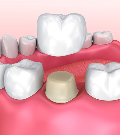 Dental crowns in Surbiton