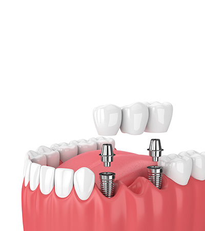 procedure for dental bridge