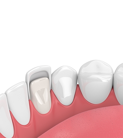 Dental veneers cost at Surbiton Dental