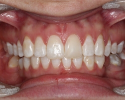 Get Straight teeth at Surbiton Dental