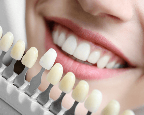 cosmetic dental bonding (1)