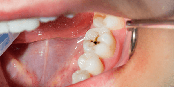 Dental cavity