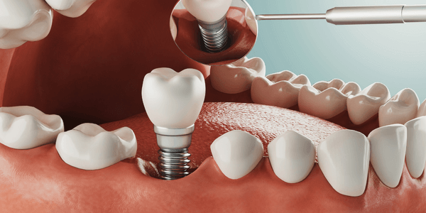 Dental implant Surbiton