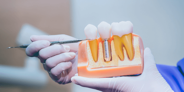 Dental implant