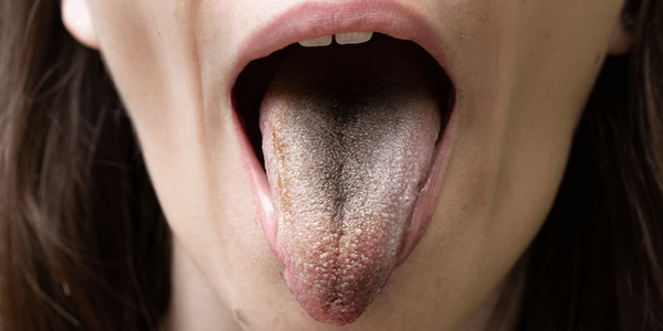 symptoms of mouth xerostomia