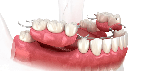 Partial denture