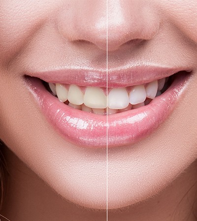 Tooth Whitening