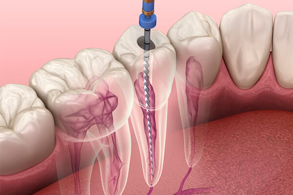 root canals surbiton