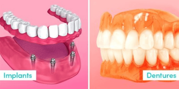 dental implant vs dentures