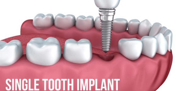 single_tooth_implant_surbiton