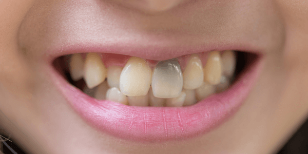 Tooth Discoloration