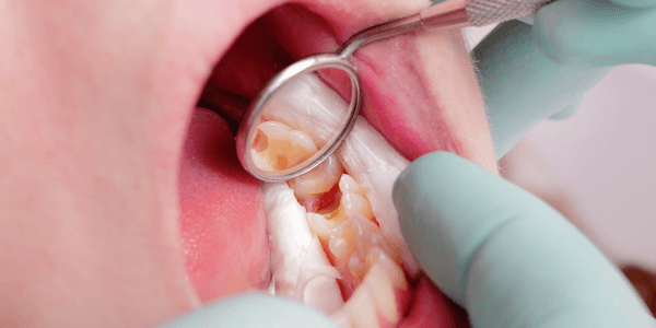 Dental cavity