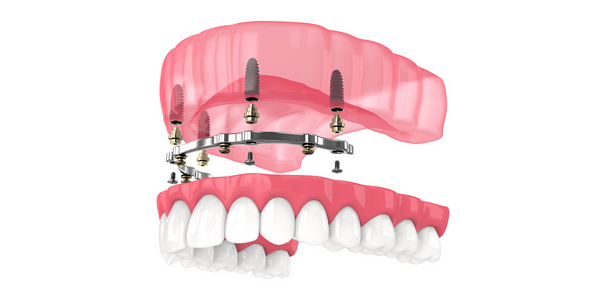 Implant bar supported dentures