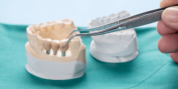 Implant retained dentures