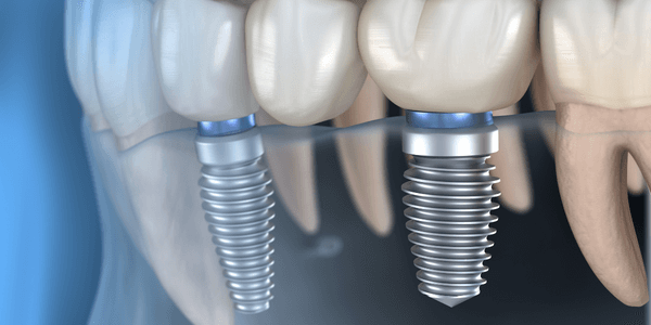 Dental implant bridge