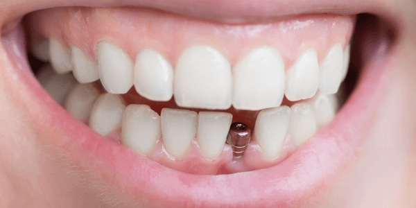 Dental implant_ Subperiosteal implants