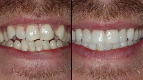 Invisalign Case Study 2 Cover Image