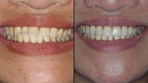 Invisalign Case Study Cover image