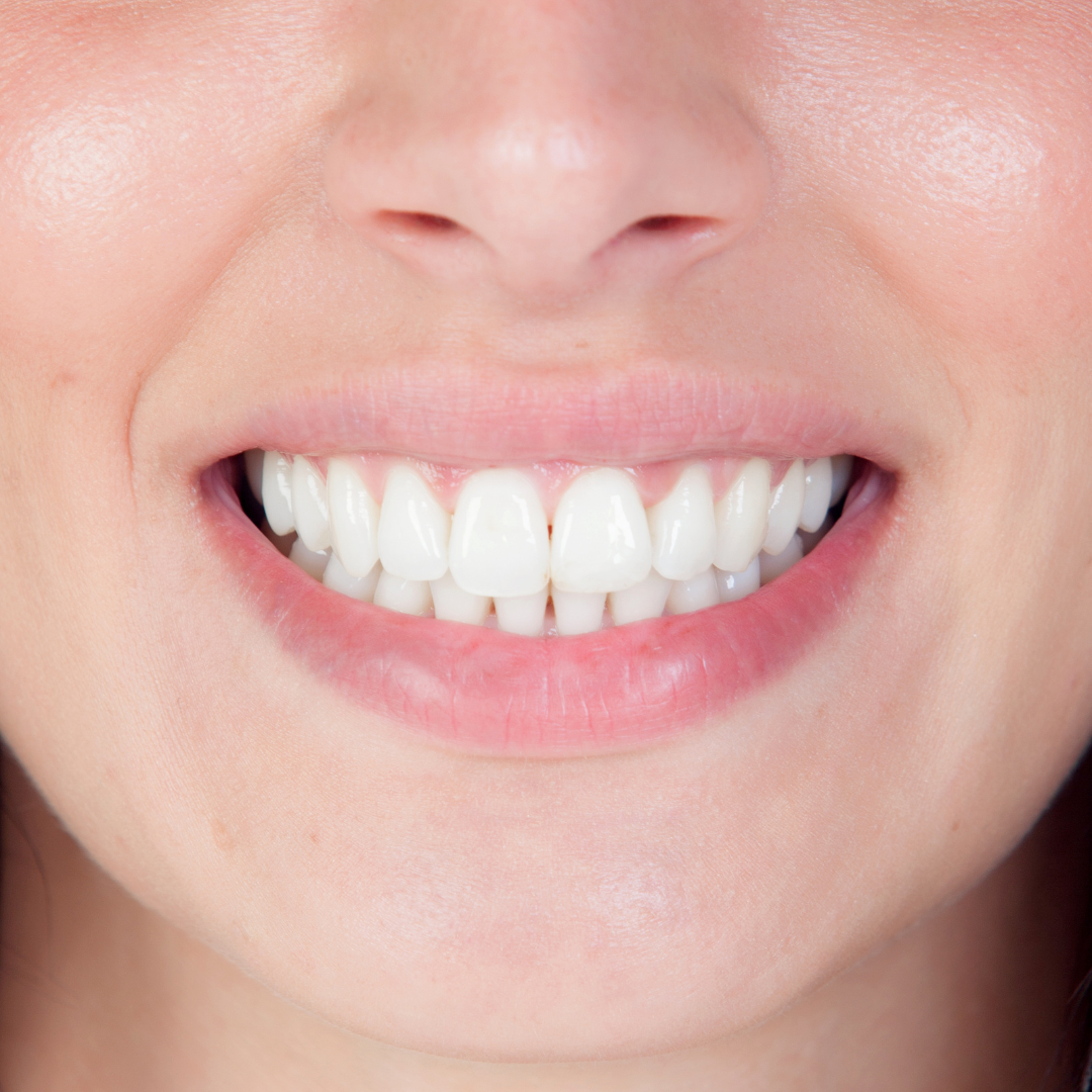 Invisalign