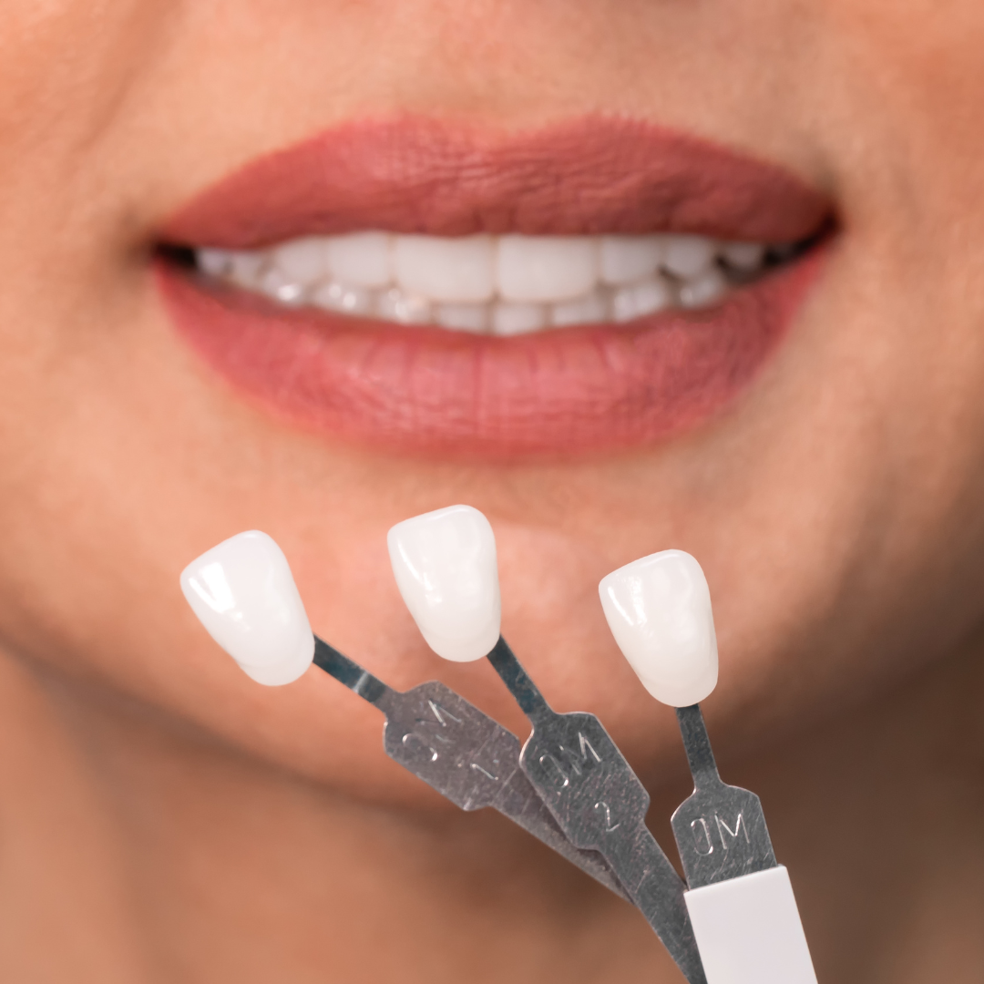 Veneers