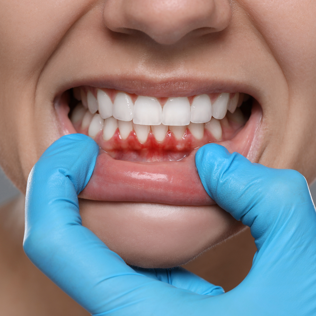 Gums