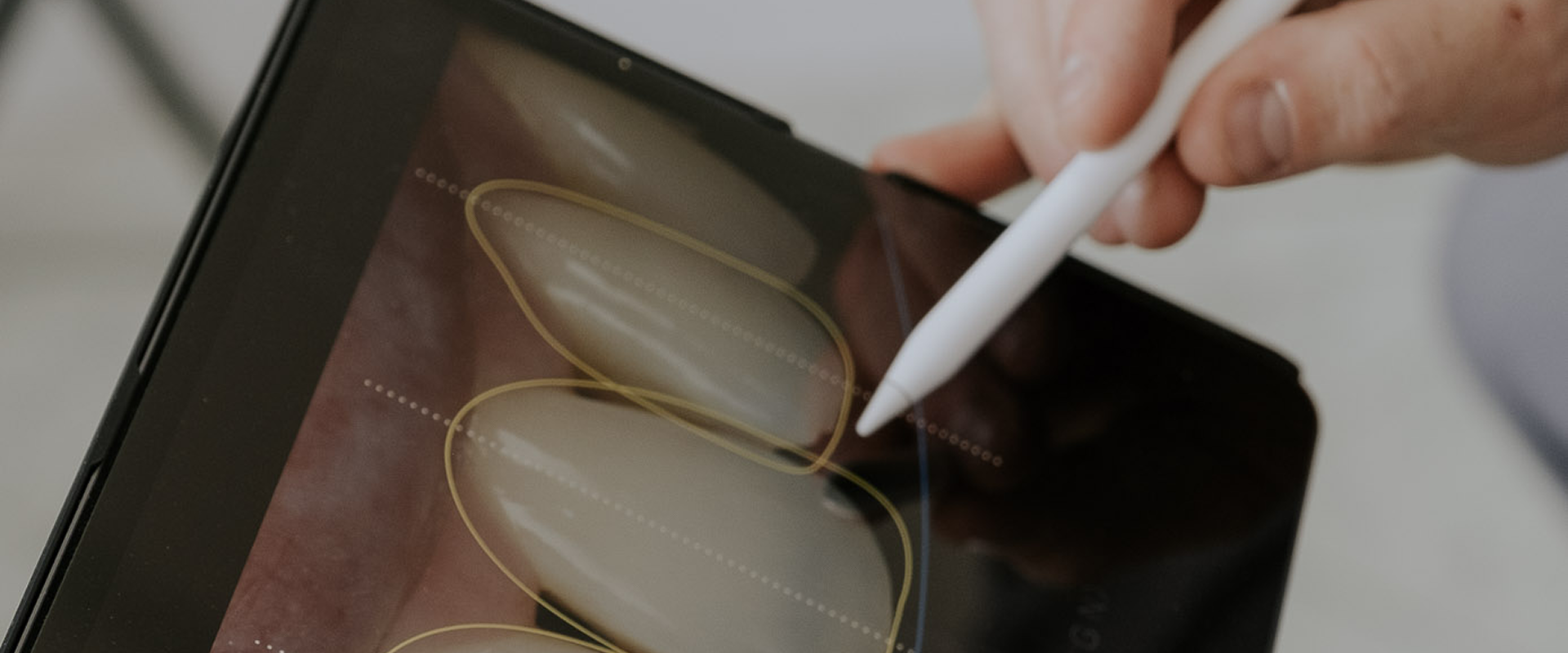 Invisalign Treatment Planning